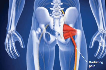 What Is Piriformis Syndrome