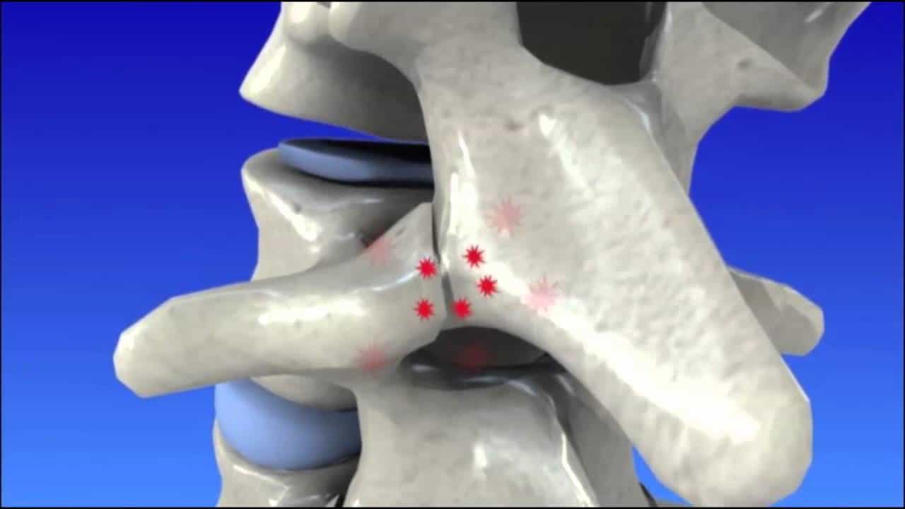 Physical Therapy For Degenerative Disc Disease