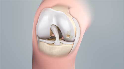 Knee Cartilage Regeneration