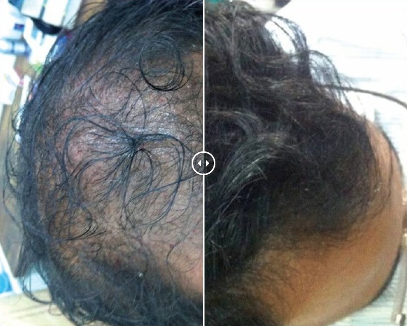 PRP Therapy For Hair Loss