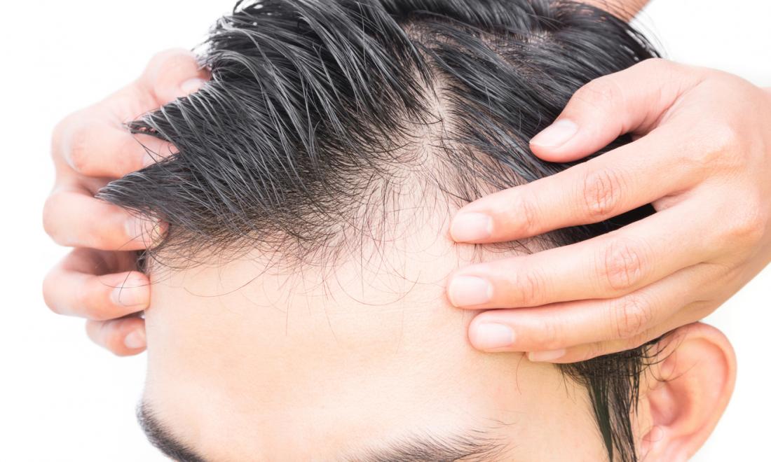 Hair Loss Treatments, Lifestyle Changes and Hair Care Tips For Men |  Advanced Health Solutions Woodstock
