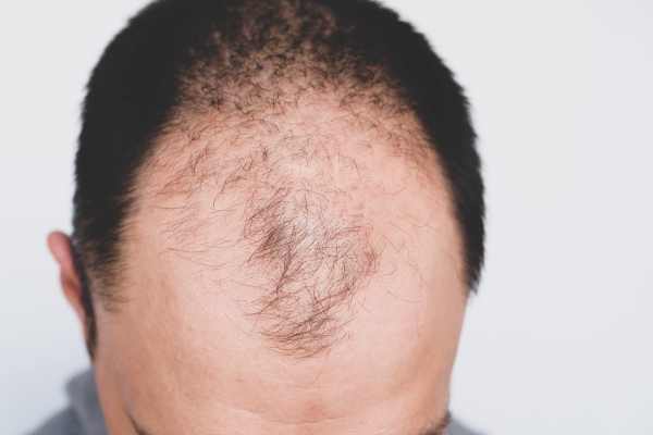Is Excessive Hair Loss Hereditary?