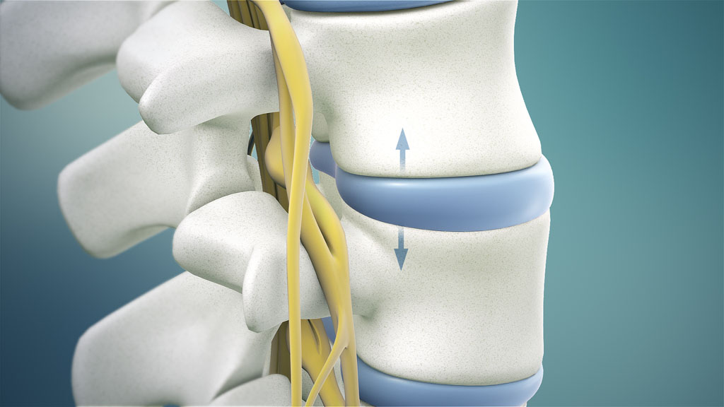 Benefits Of Spinal Decompression