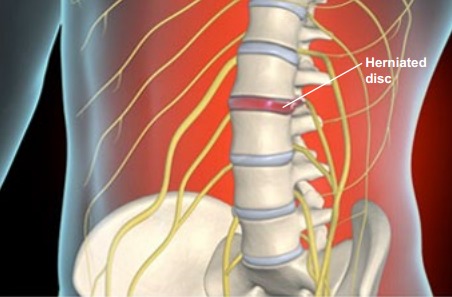 Advanced Health Solutions: facet joint injection