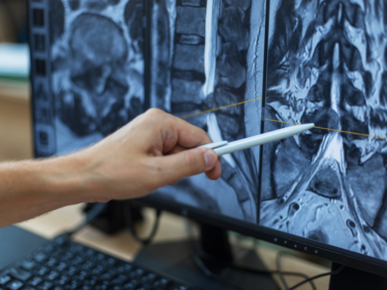 Advanced Health Solutions: doctor pointing a pen at a spine MRI scan on a computer screen